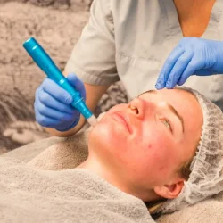 microneedling-v1-x1920.png